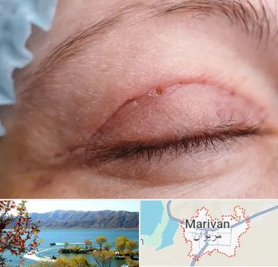 جراح پلک در مریوان