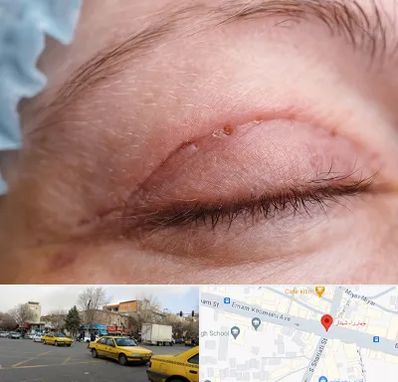 جراح پلک در شهناز تبریز