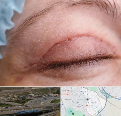 جراح پلک در یاغچیان تبریز