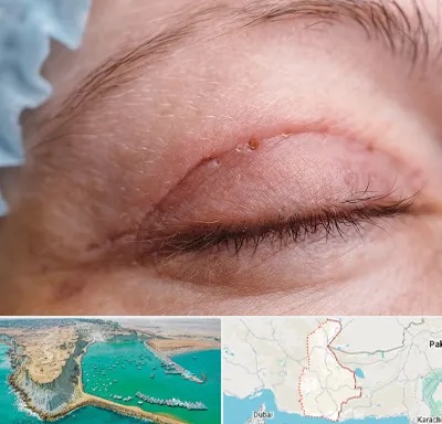 جراح پلک در سیستان و بلوچستان