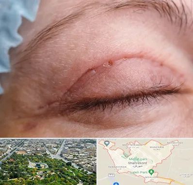 جراح پلک در شهرکرد