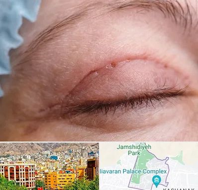 جراح پلک در نیاوران 