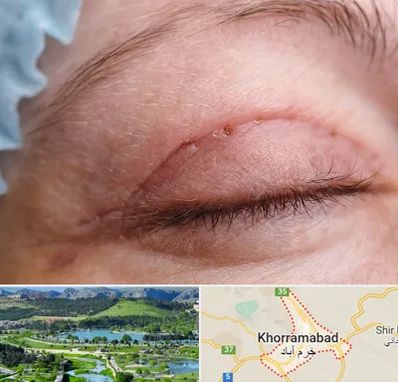 جراح پلک در خرم آباد