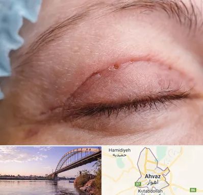 جراح پلک در اهواز