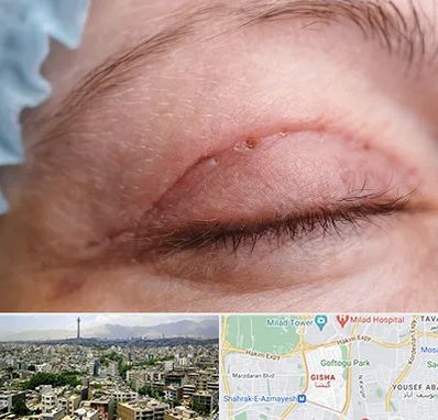 جراح پلک در گیشا 
