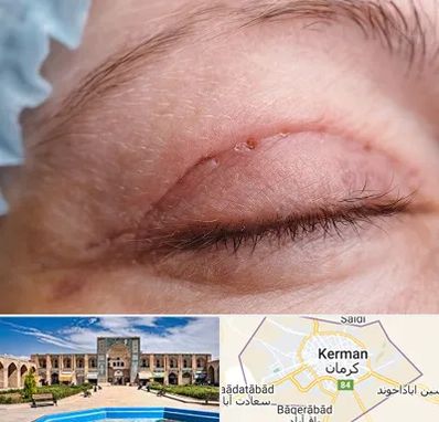 جراح پلک در کرمان