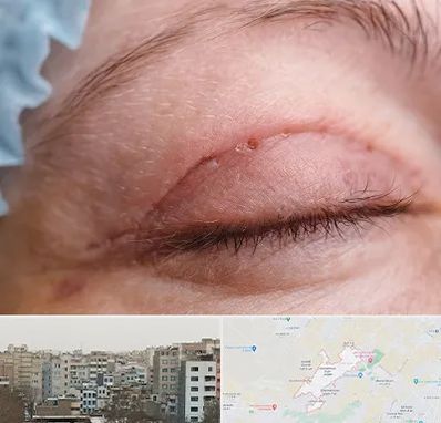 جراح پلک در محمد شهر کرج 