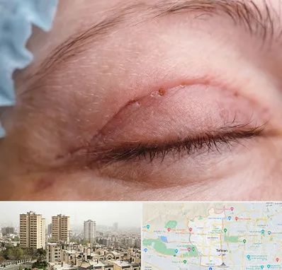 جراح پلک در منطقه 5 تهران 