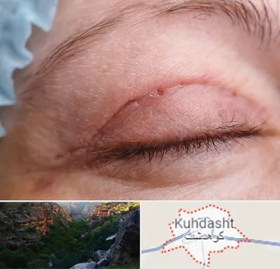 جراح پلک در کوهدشت