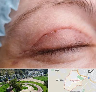 جراح پلک در مهرشهر کرج 
