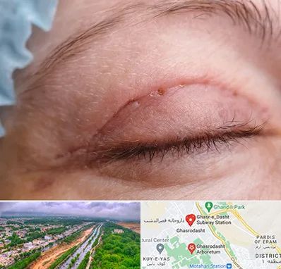 جراح پلک در قصرالدشت شیراز