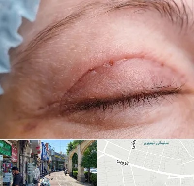 جراح پلک در خیابان قزوین