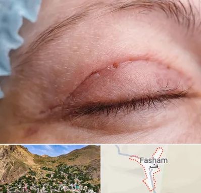 جراح پلک در فشم