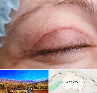 جراح پلک در خراسان شمالی