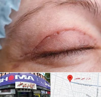 جراح پلک در امین حضور