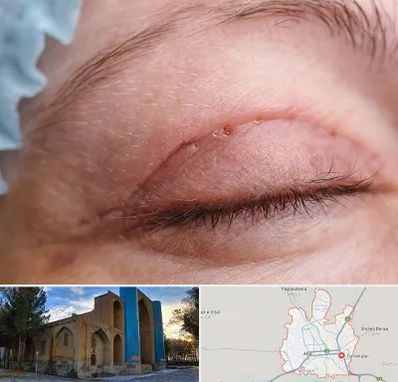 جراح پلک در اهر