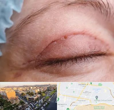 جراح پلک در تهرانپارس 