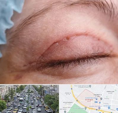 جراح پلک در گلشهر کرج