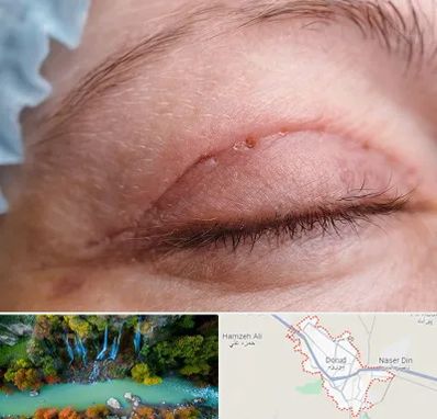 جراح پلک در دورود