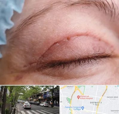 جراح پلک در ظفر 