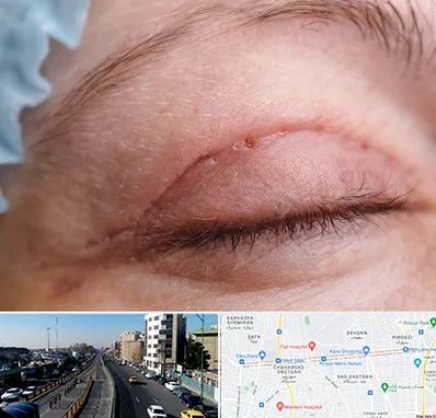 جراح پلک در پیروزی 