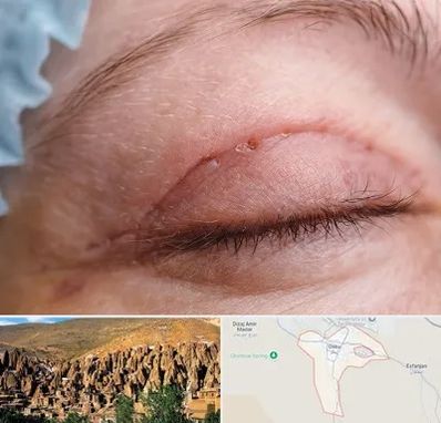 جراح پلک در اسکو