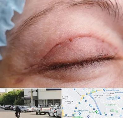 جراح پلک در قدوسی شرقی شیراز