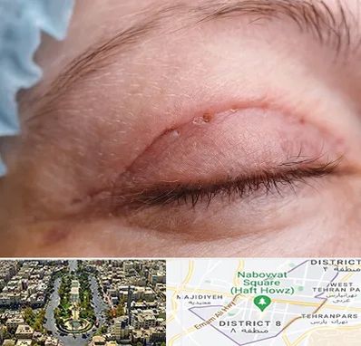 جراح پلک در نارمک 