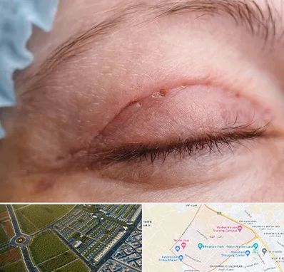 جراح پلک در الهیه مشهد