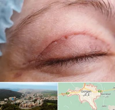 جراح پلک در گرگان