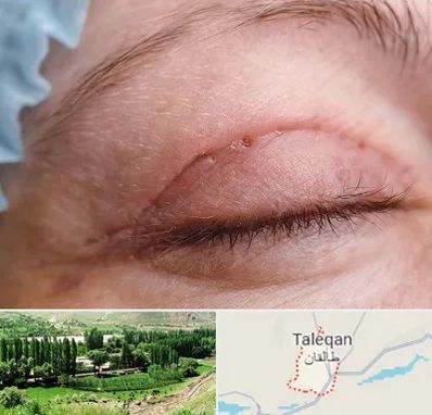 جراح پلک در طالقان