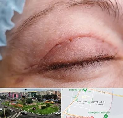 جراح پلک در تهرانسر 