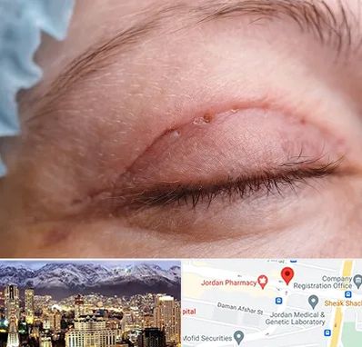 جراح پلک در جردن 