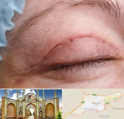 جراح پلک در سمنان