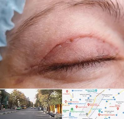 جراح پلک در شریعتی 