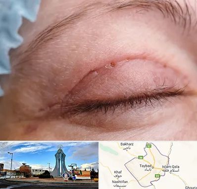 جراح پلک در تایباد