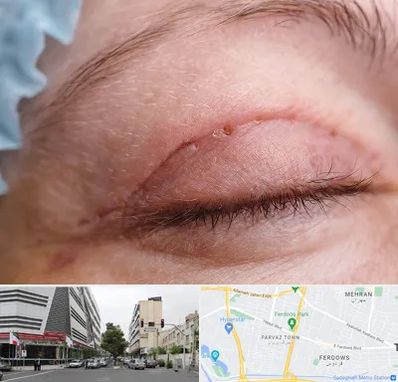 جراح پلک در بلوار فردوس 