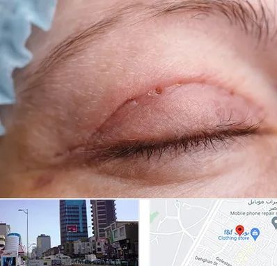 جراح پلک در چهارراه طالقانی کرج