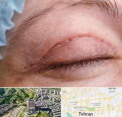 جراح پلک در شمال تهران 