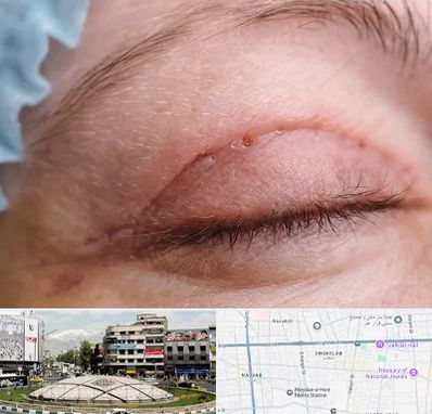 جراح پلک در مرکز تهران