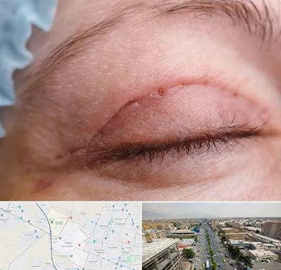 جراح پلک در حصارک کرج