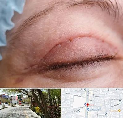 جراح پلک در خیابان توحید اصفهان