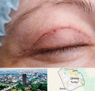 جراح پلک در ارومیه