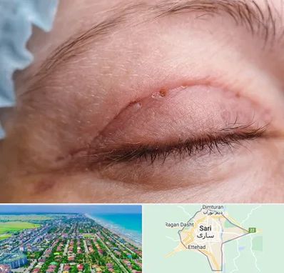 جراح پلک در ساری