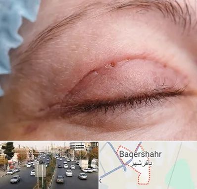 جراح پلک در باقرشهر