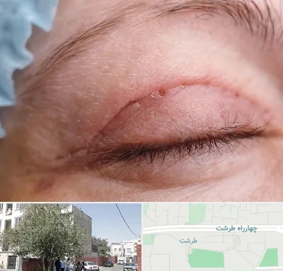 جراح پلک در طرشت