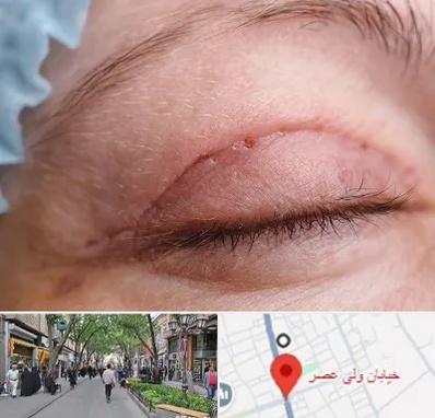 جراح پلک در ولیعصر شهریار