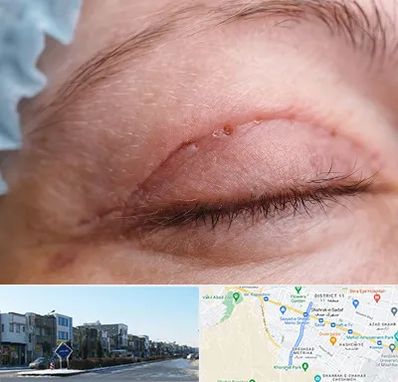 جراح پلک در شریعتی مشهد
