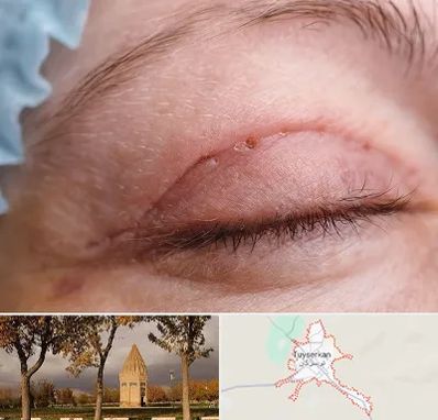 جراح پلک در تویسرکان