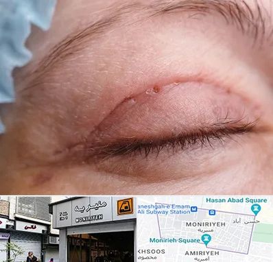 جراح پلک در منیریه 
